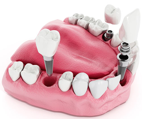 Exemplo de uma prótese fixa (unitária) sobre o implante dentário