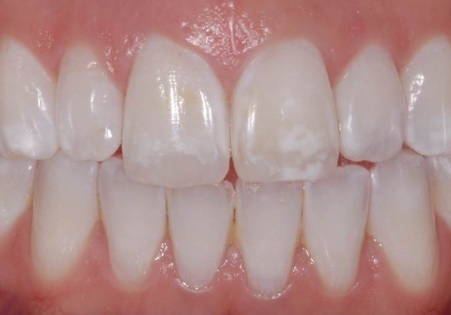 Manchas Brancas No Dente