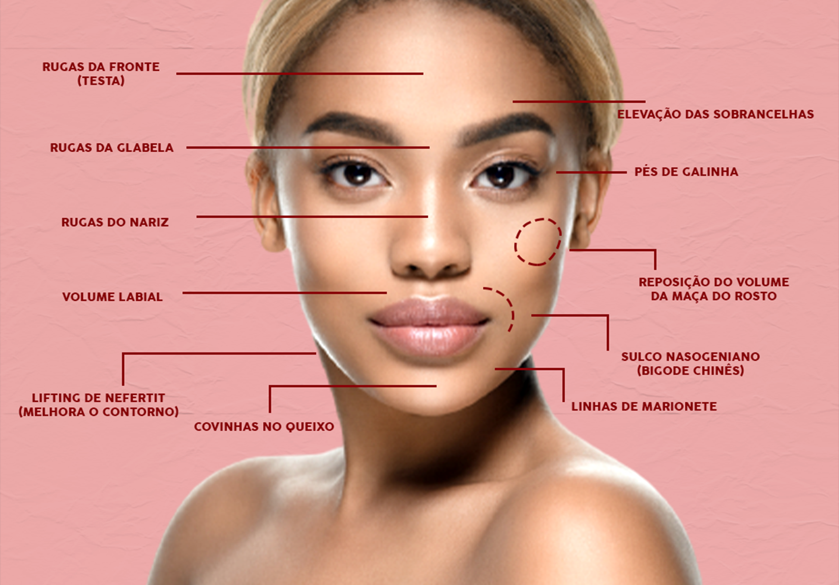 Botox